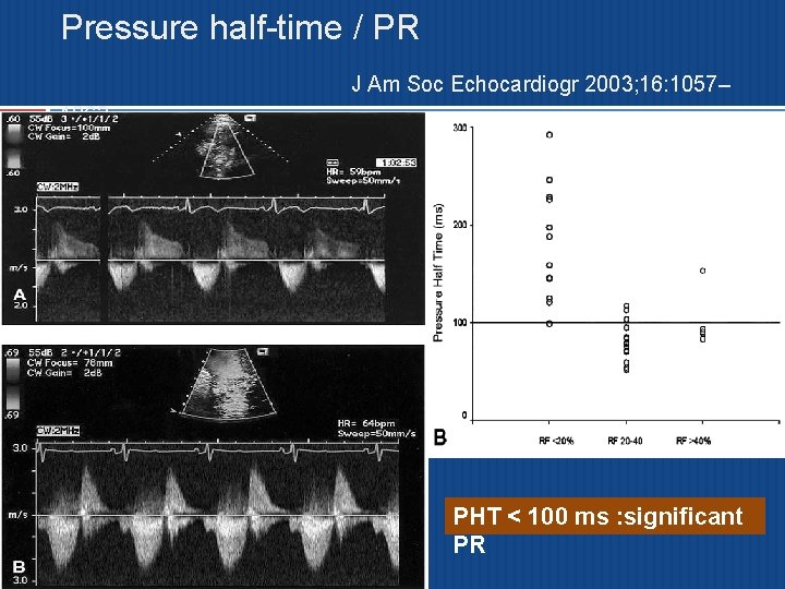 Pressure half-time / PR J Am Soc Echocardiogr 2003; 16: 1057– 1062 PHT <