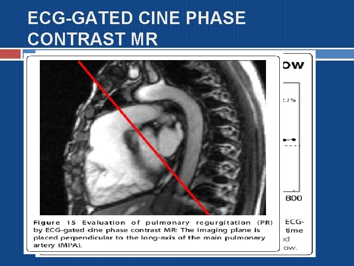 ECG-GATED CINE PHASE CONTRAST MR 