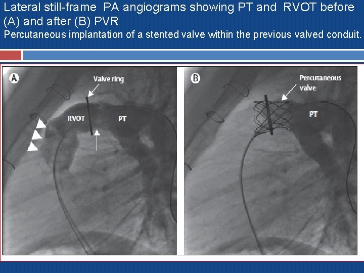 Lateral still-frame PA angiograms showing PT and RVOT before (A) and after (B) PVR