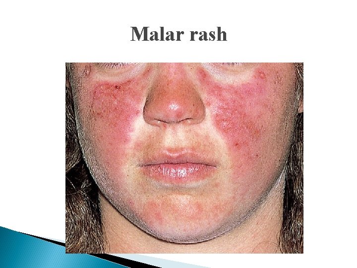 Malar rash 