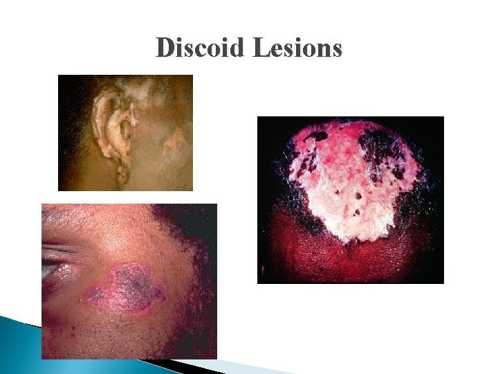 Discoid Lesions 