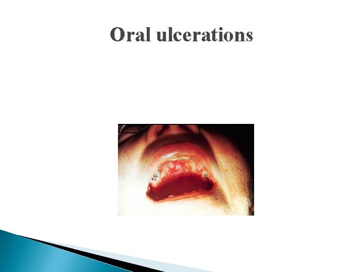 Oral ulcerations 