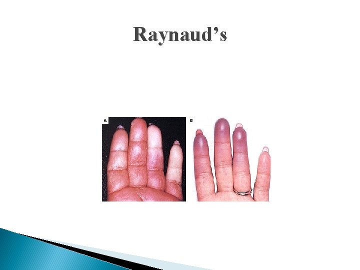 Raynaud’s 