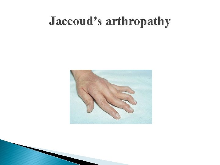 Jaccoud’s arthropathy 