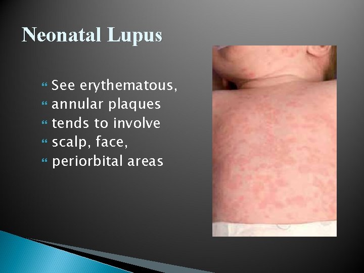 Neonatal Lupus See erythematous, annular plaques tends to involve scalp, face, periorbital areas 