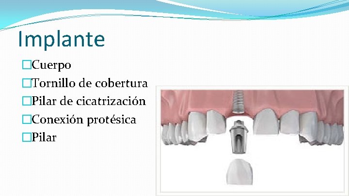 Implante �Cuerpo �Tornillo de cobertura �Pilar de cicatrización �Conexión protésica �Pilar 