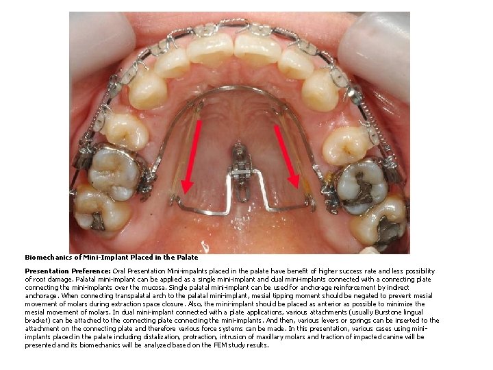 Biomechanics of Mini-Implant Placed in the Palate Presentation Preference: Oral Presentation Mini-impalnts placed in