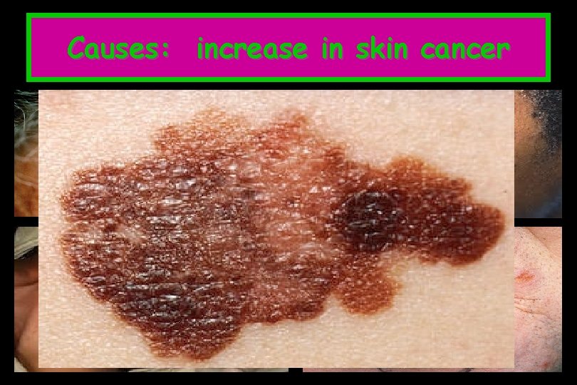 Causes: increase in skin cancer 
