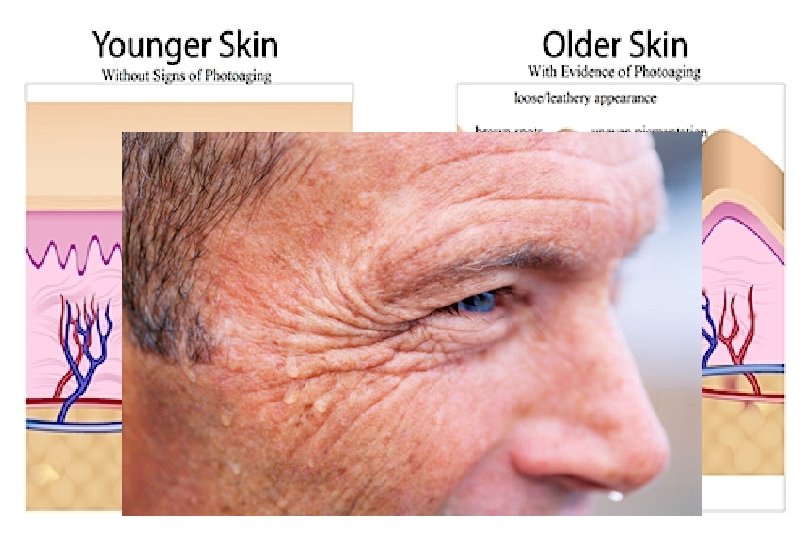 Premature aging of skin 