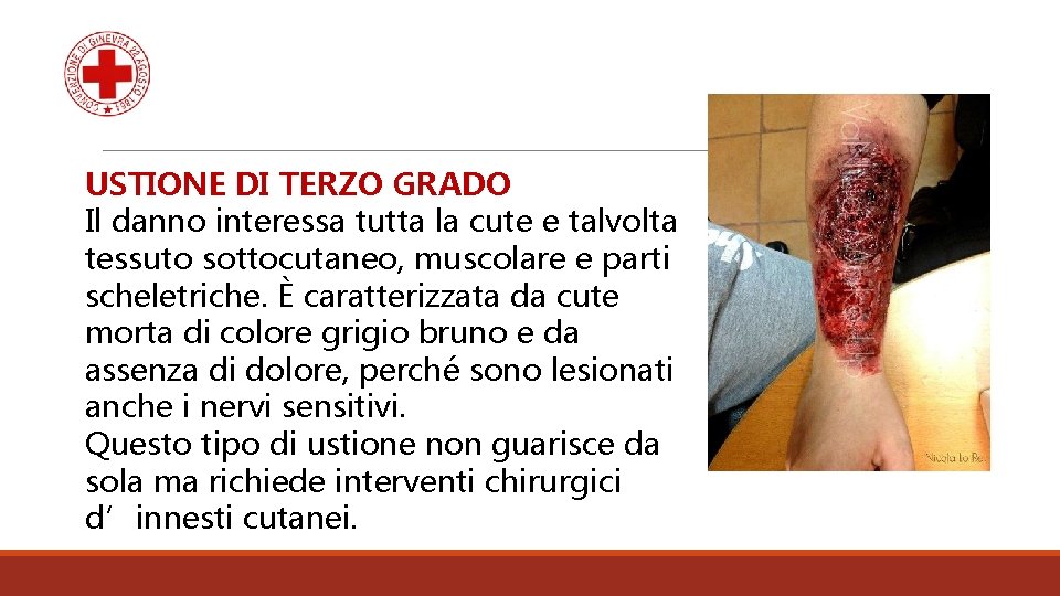 USTIONE DI TERZO GRADO Il danno interessa tutta la cute e talvolta tessuto sottocutaneo,