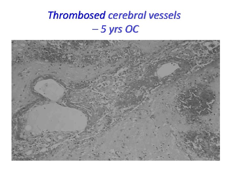 Thrombosed cerebral vessels – 5 yrs OC 