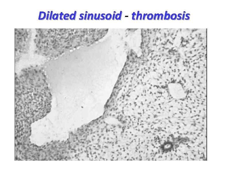 Dilated sinusoid - thrombosis 