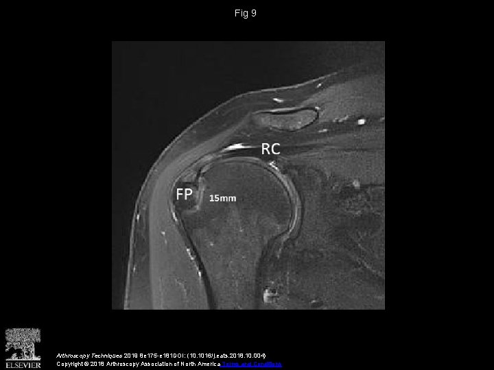 Fig 9 Arthroscopy Techniques 2019 8 e 175 -e 181 DOI: (10. 1016/j. eats. Fig 9 Arthroscopy Techniques 2019 8 e 175 -e 181 DOI: (10. 1016/j. eats.