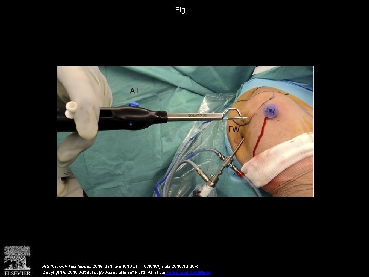 Fig 1 Arthroscopy Techniques 2019 8 e 175 -e 181 DOI: (10. 1016/j. eats. Fig 1 Arthroscopy Techniques 2019 8 e 175 -e 181 DOI: (10. 1016/j. eats.