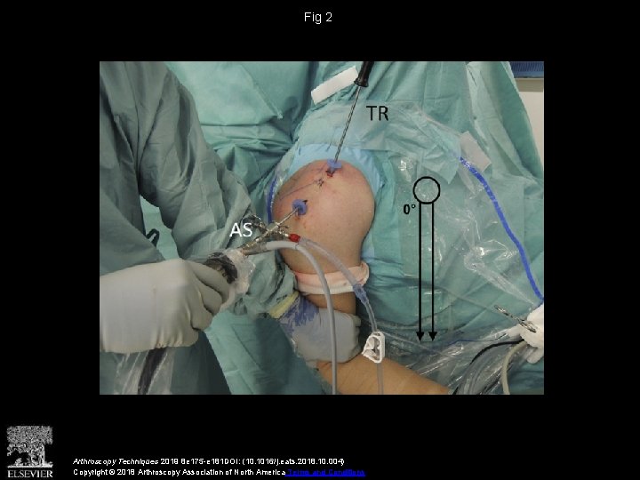 Fig 2 Arthroscopy Techniques 2019 8 e 175 -e 181 DOI: (10. 1016/j. eats. Fig 2 Arthroscopy Techniques 2019 8 e 175 -e 181 DOI: (10. 1016/j. eats.