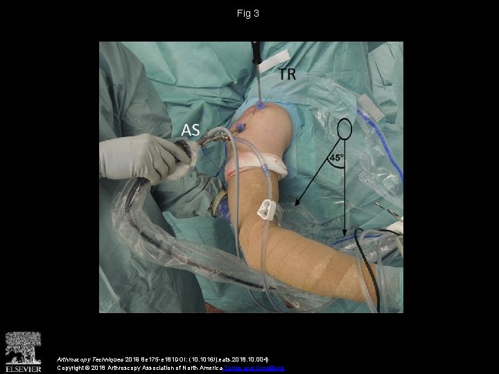 Fig 3 Arthroscopy Techniques 2019 8 e 175 -e 181 DOI: (10. 1016/j. eats. Fig 3 Arthroscopy Techniques 2019 8 e 175 -e 181 DOI: (10. 1016/j. eats.