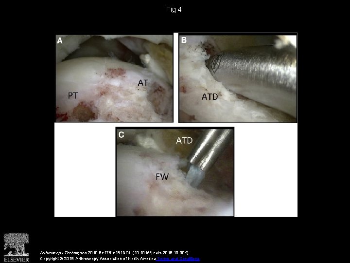 Fig 4 Arthroscopy Techniques 2019 8 e 175 -e 181 DOI: (10. 1016/j. eats. Fig 4 Arthroscopy Techniques 2019 8 e 175 -e 181 DOI: (10. 1016/j. eats.