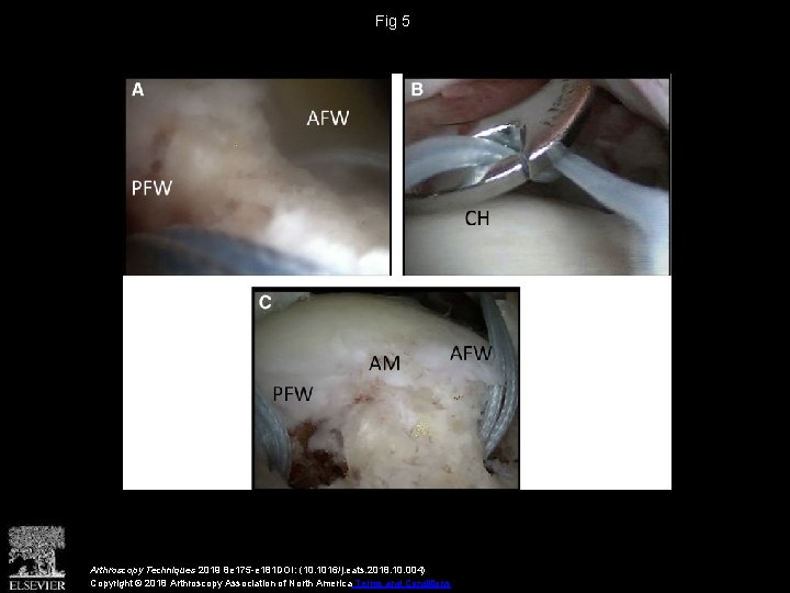 Fig 5 Arthroscopy Techniques 2019 8 e 175 -e 181 DOI: (10. 1016/j. eats. Fig 5 Arthroscopy Techniques 2019 8 e 175 -e 181 DOI: (10. 1016/j. eats.