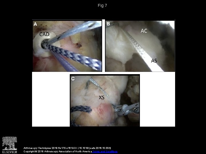 Fig 7 Arthroscopy Techniques 2019 8 e 175 -e 181 DOI: (10. 1016/j. eats. Fig 7 Arthroscopy Techniques 2019 8 e 175 -e 181 DOI: (10. 1016/j. eats.