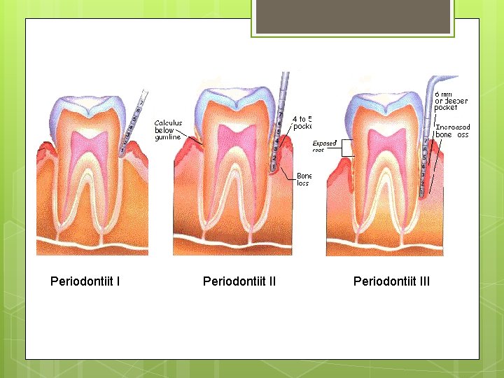 Periodontiit III 