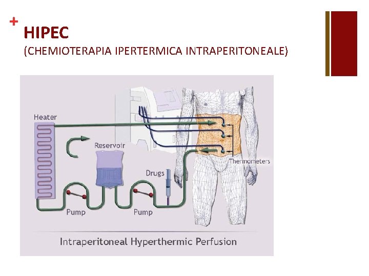 + HIPEC (CHEMIOTERAPIA IPERTERMICA INTRAPERITONEALE) 