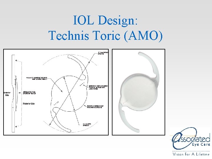 IOL Design: Technis Toric (AMO) IOL Design: Technis Toric (AMO)