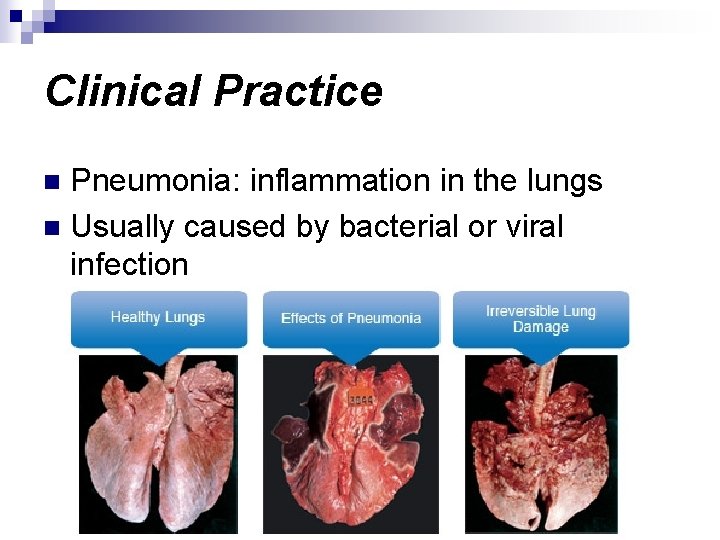 Clinical Practice Pneumonia: inflammation in the lungs n Usually caused by bacterial or viral