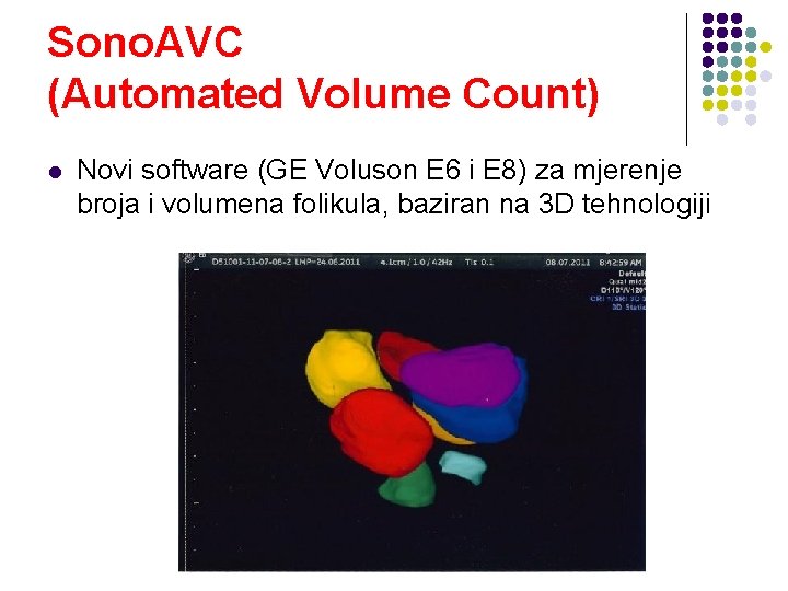 Sono. AVC (Automated Volume Count) l Novi software (GE Voluson E 6 i E