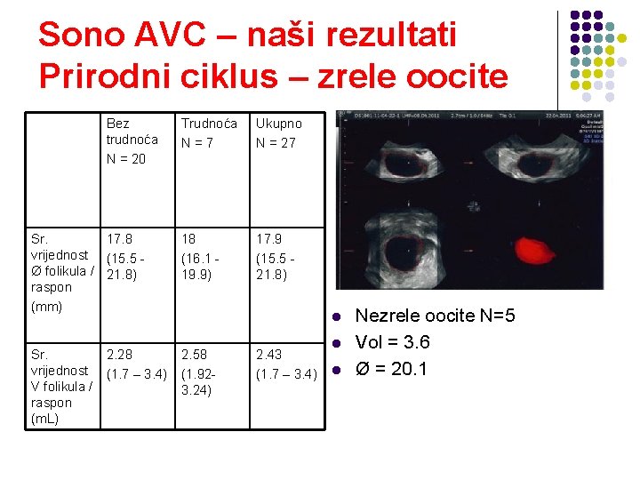 Sono AVC – naši rezultati Prirodni ciklus – zrele oocite Bez trudnoća N =