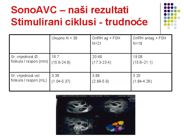 Sono. AVC – naši rezultati Stimulirani ciklusi - trudnoće Ukupno N = 39 Gn.