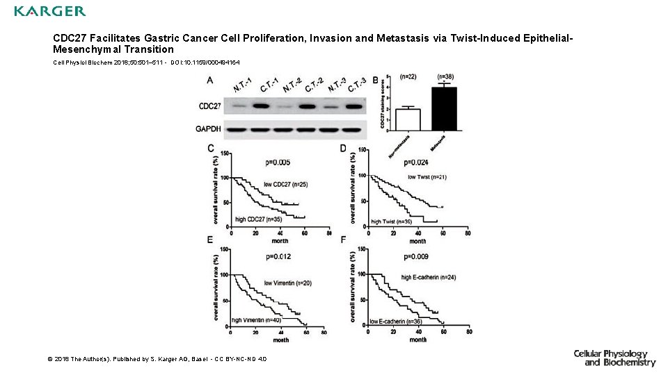 CDC 27 Facilitates Gastric Cancer Cell Proliferation, Invasion and Metastasis via Twist-Induced Epithelial. Mesenchymal