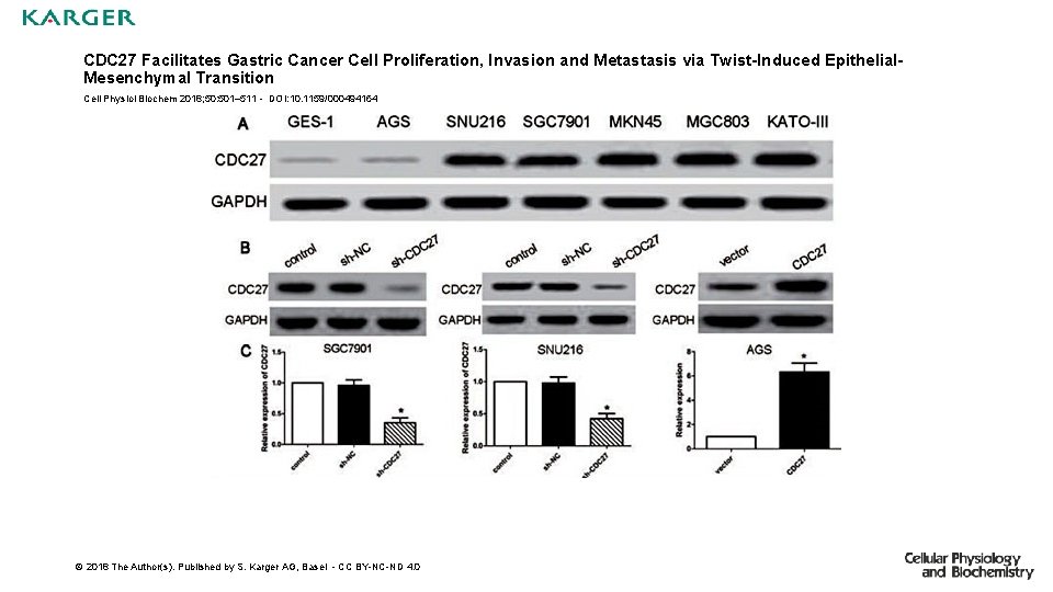 CDC 27 Facilitates Gastric Cancer Cell Proliferation, Invasion and Metastasis via Twist-Induced Epithelial. Mesenchymal