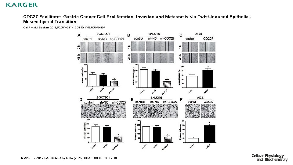 CDC 27 Facilitates Gastric Cancer Cell Proliferation, Invasion and Metastasis via Twist-Induced Epithelial. Mesenchymal