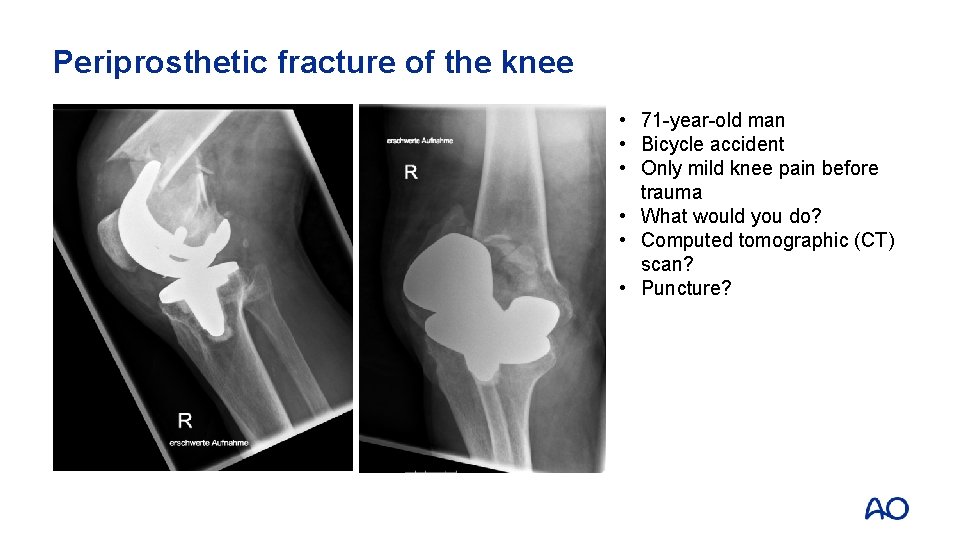 Periprosthetic fracture of the knee • 71 -year-old man • Bicycle accident • Only