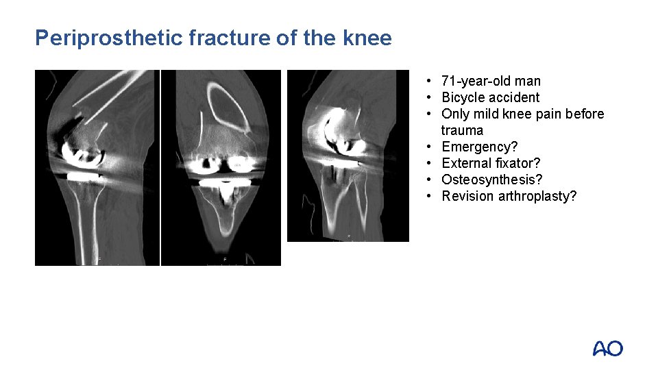 Periprosthetic fracture of the knee • 71 -year-old man • Bicycle accident • Only