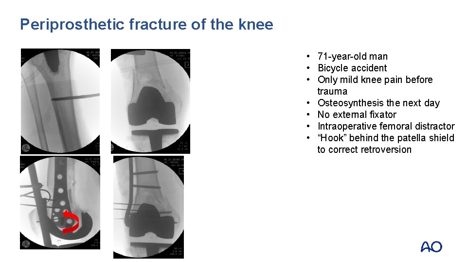 Periprosthetic fracture of the knee • 71 -year-old man • Bicycle accident • Only