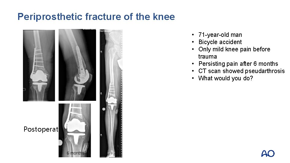 Periprosthetic fracture of the knee • 71 -year-old man • Bicycle accident • Only