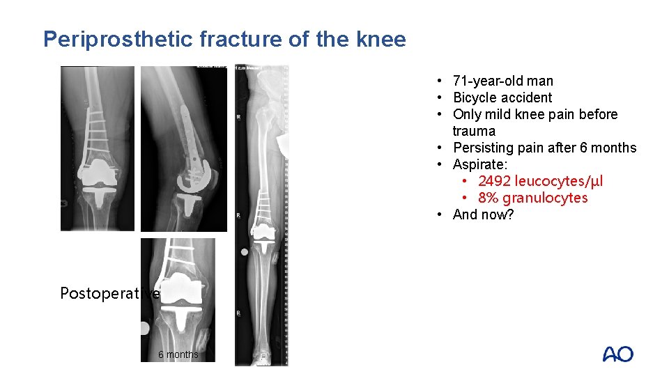 Periprosthetic fracture of the knee • 71 -year-old man • Bicycle accident • Only