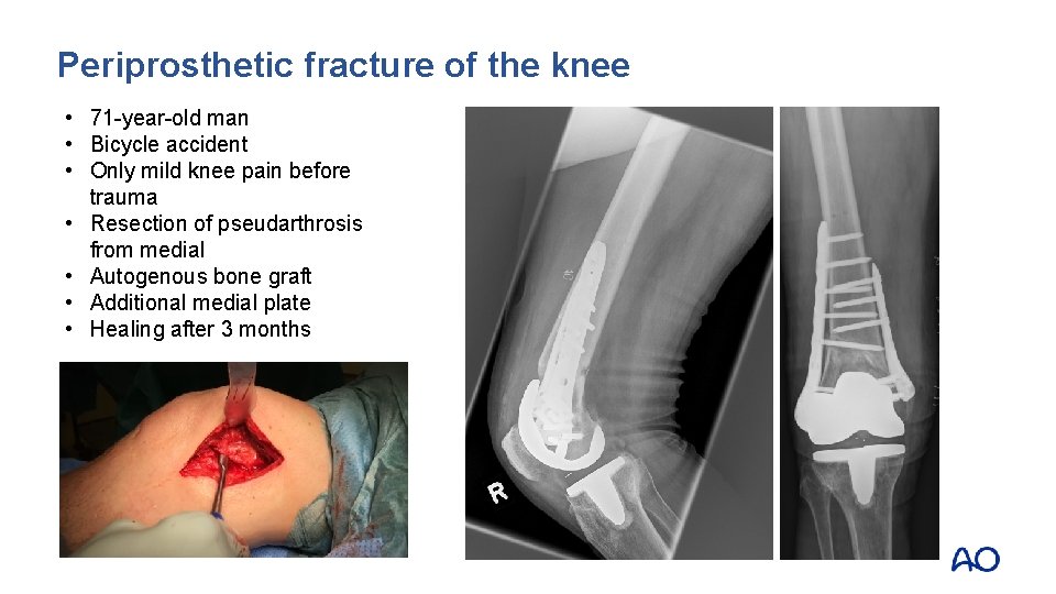 Periprosthetic fracture of the knee • 71 -year-old man • Bicycle accident • Only