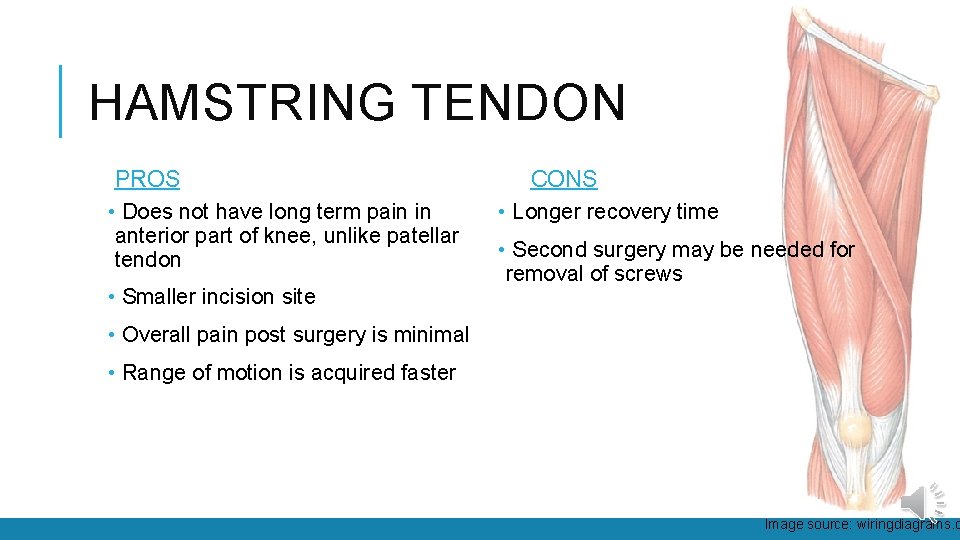 HAMSTRING TENDON PROS • Does not have long term pain in anterior part of