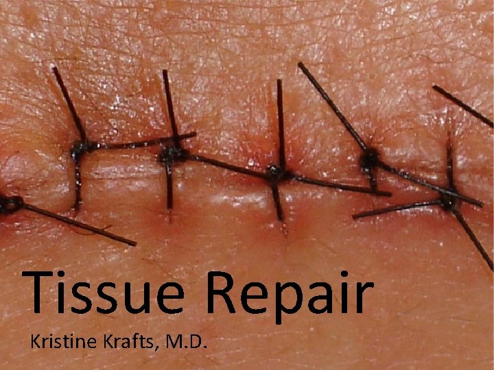 Tissue Repair Kristine Krafts, M. D. 