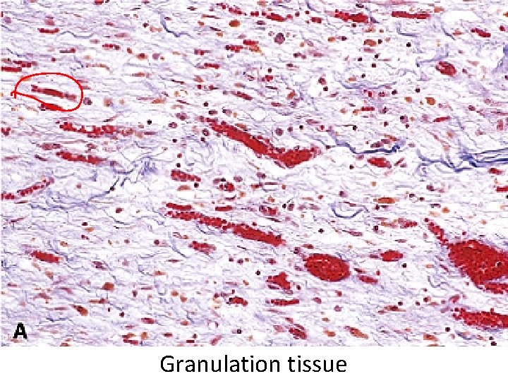 Granulation tissue 