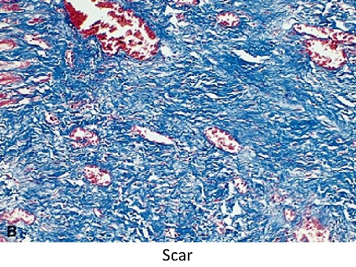 Scar 