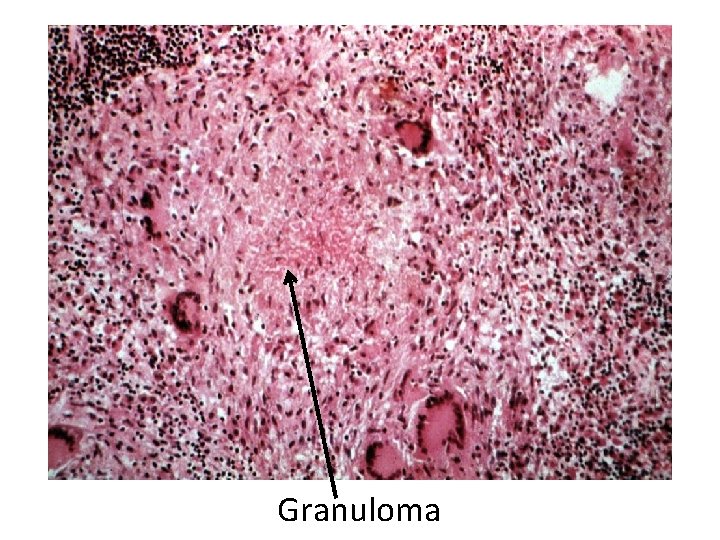 Granuloma 