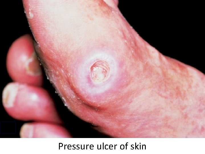 Pressure ulcer of skin 