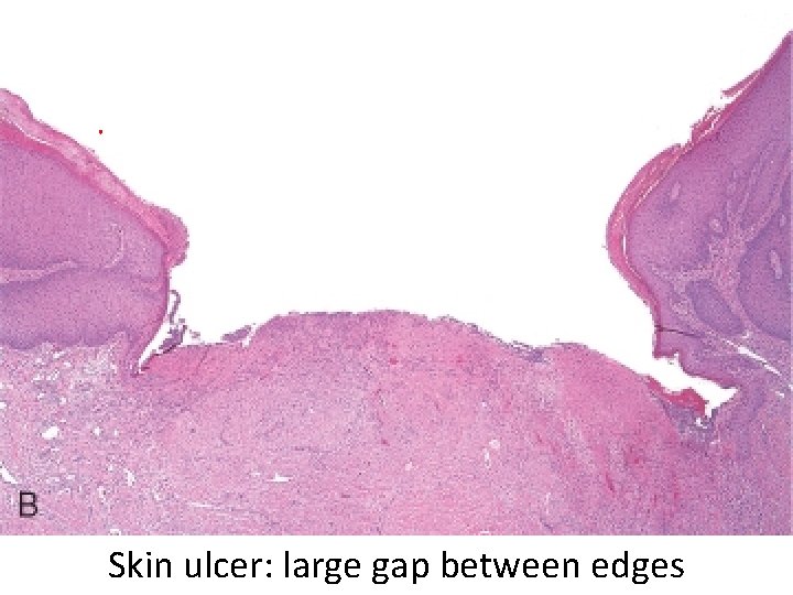 Skin ulcer: large gap between edges 