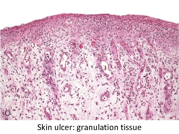 Skin ulcer: granulation tissue 