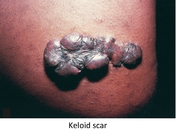 Keloid scar 