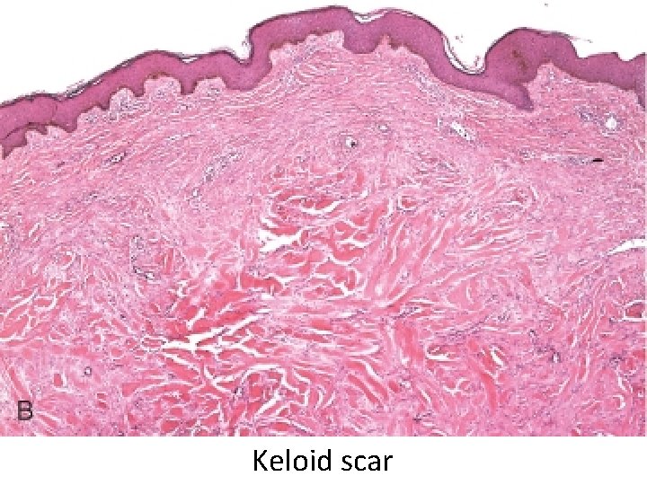 Keloid scar 