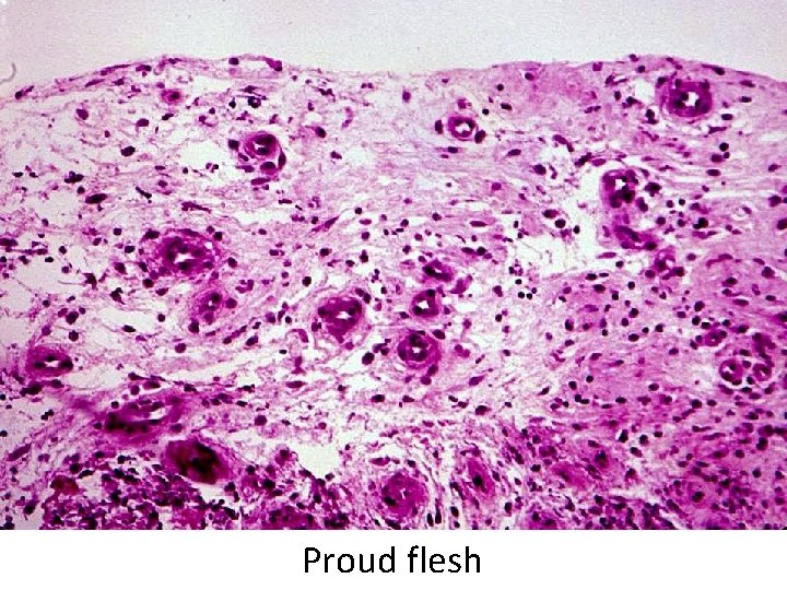 Proud flesh 